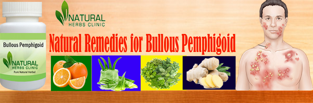 Natural Remedies for Bullous Pemphigoid Natural Remedies for Bullous Pemphigoid