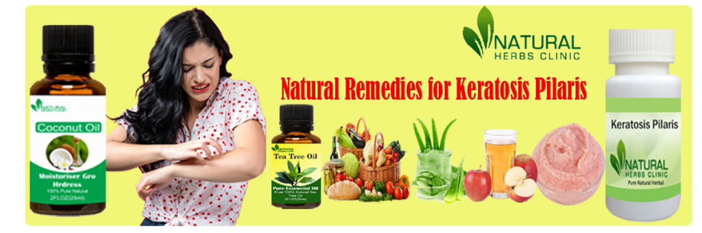 Natural Remedies for Keratosis Pilaris