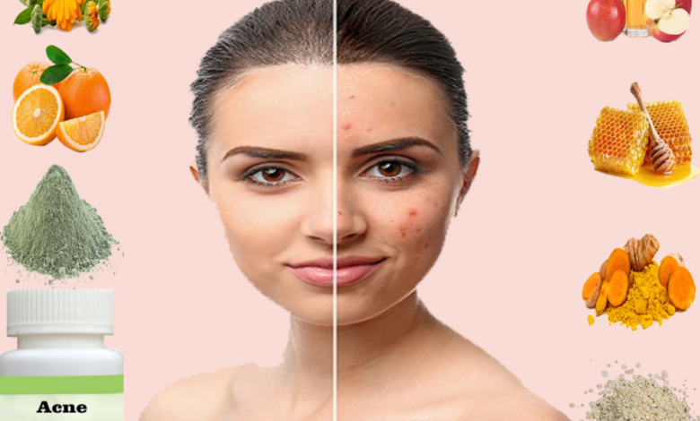 Proven-Natural-Remedies-for-Acne-1024x853