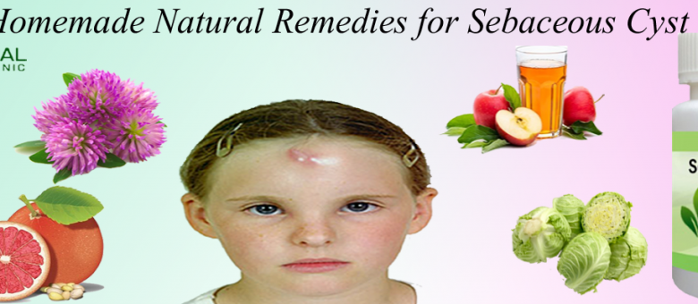 Homemade-Natural-Remedies-for-Sebaceous-Cyst-1024x340