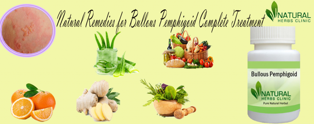 Natural Remedies for Bullous Pemphigoid Natural Remedies for Bullous Pemphigoid