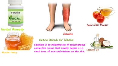 Natural-Remedies-for-Cellulitis-1