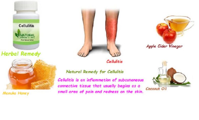 Natural-Remedies-for-Cellulitis-1