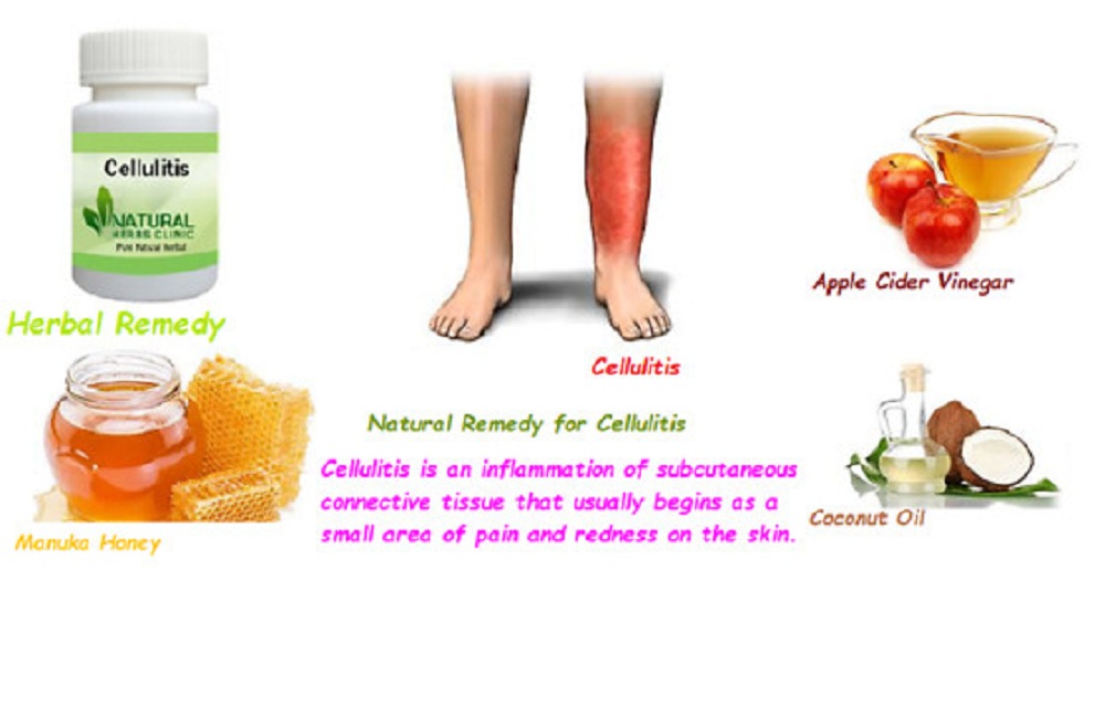 Natural Remedies for Cellulitis