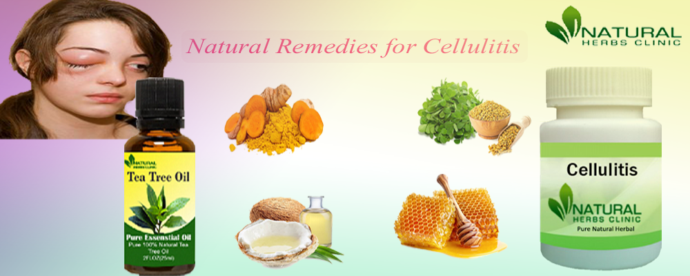 Natural Remedies for Cellulitis