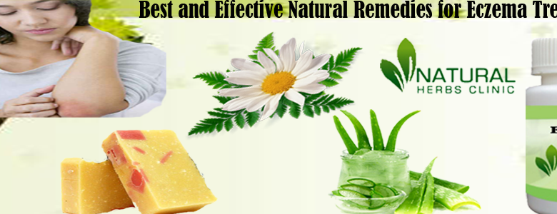 Natural-Remedies-for-Eczema