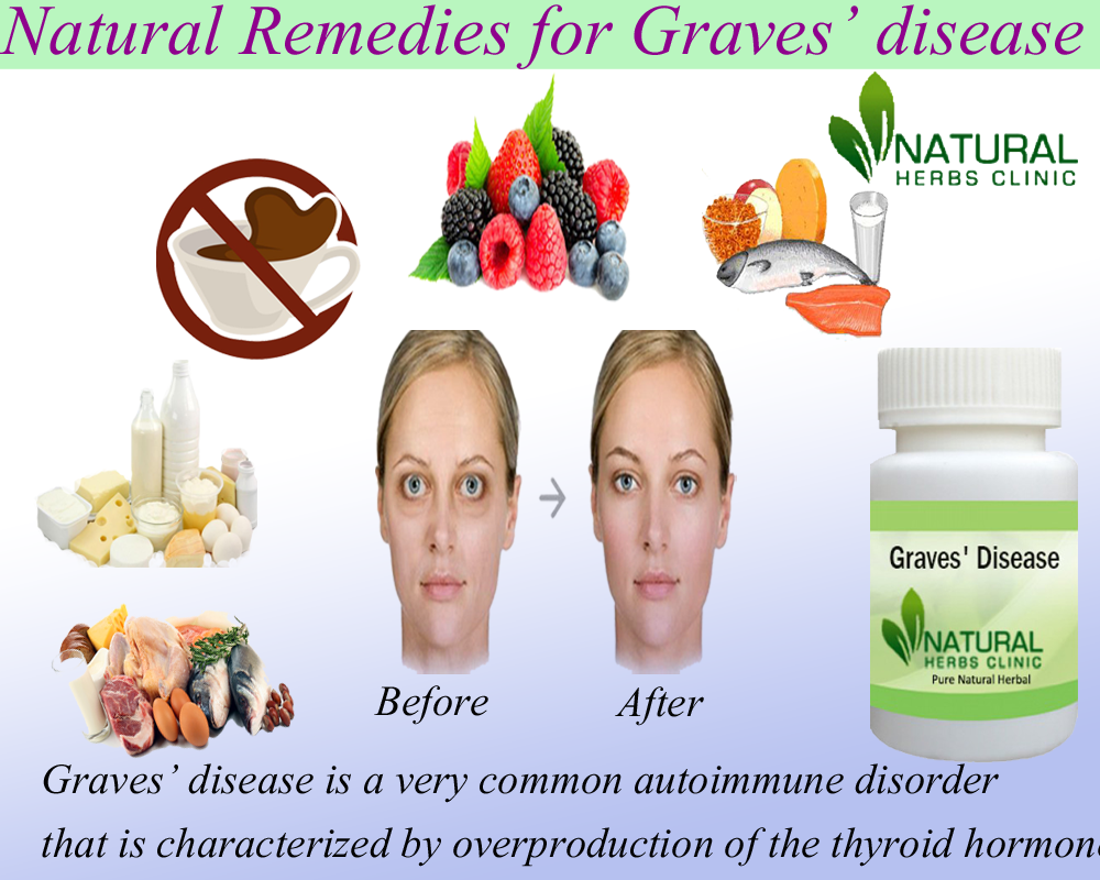 Natural Remedies to treat the Autoimmune Disorder Graves’ disease