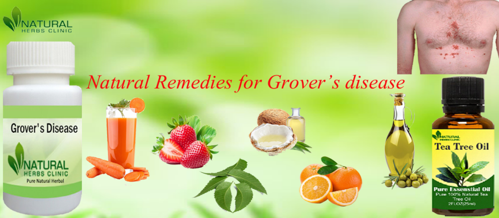Natural Remedies for Grover’s disease