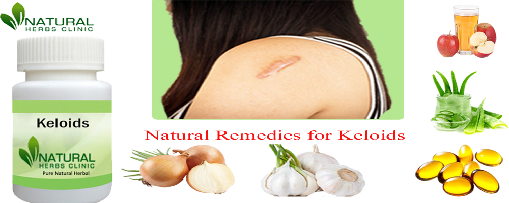 Natural Remedies for Keloids