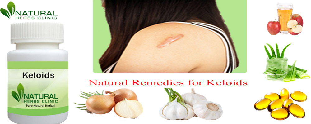 Natural Remedies for Keloids Natural Remedies for Keloids