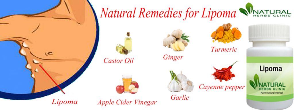 Natural Remedies for Lipoma