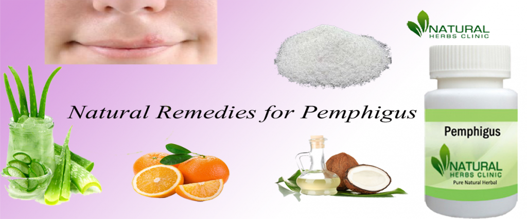 Natural Remedies for Pemphigus