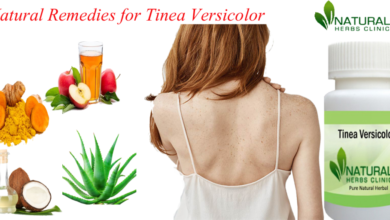 Natural-Remedies-for-Tinea-Versicolor-1024x512