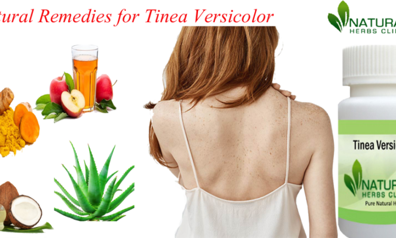 Natural-Remedies-for-Tinea-Versicolor-1024x512