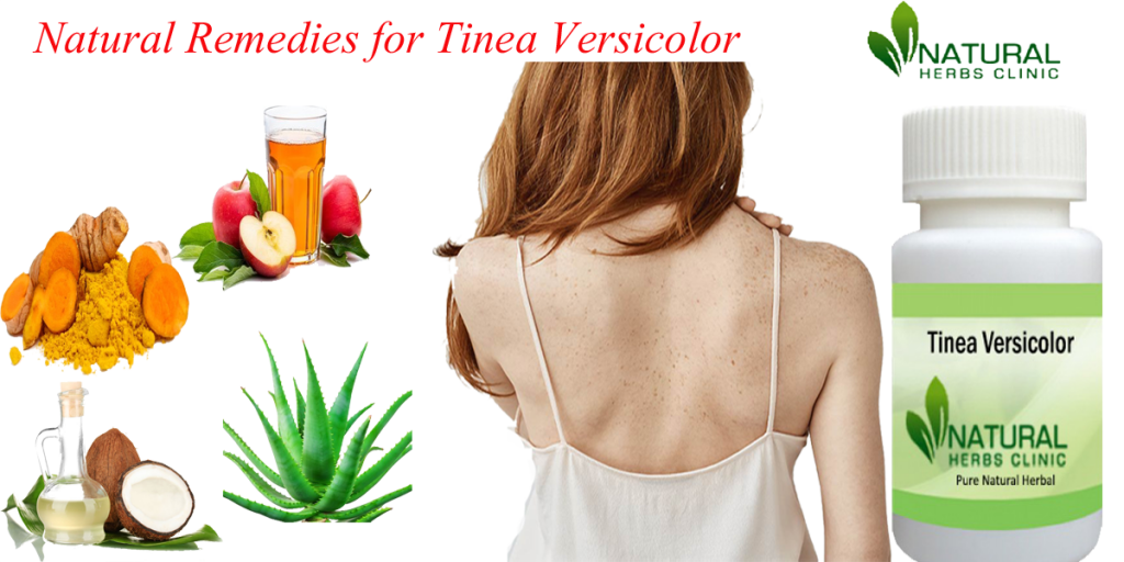 Natural Remedies for Tinea Versicolor