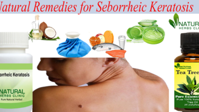 Natural-remedies-for-seborrheic-keratosis