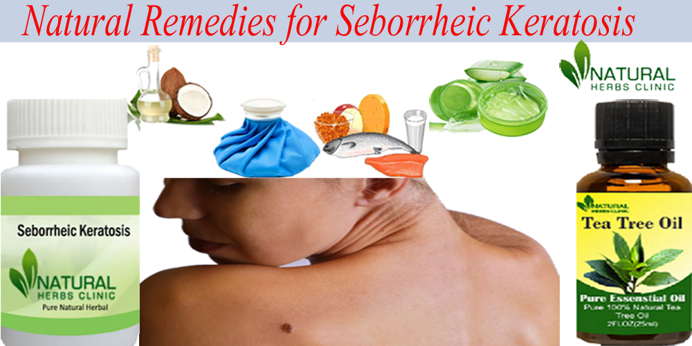 Natural remedies for seborrheic keratosis