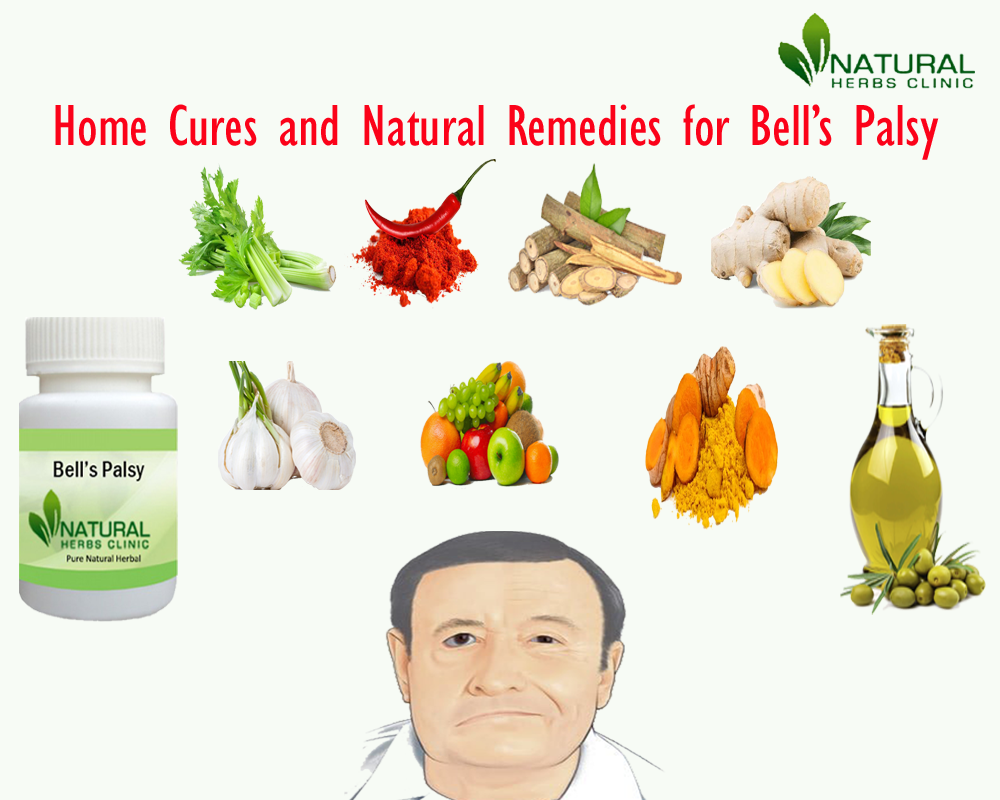 Natural Remedies for Bell’s Palsy