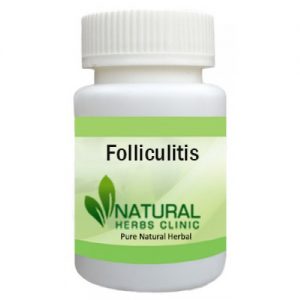 Herbal Product for Folliculitis