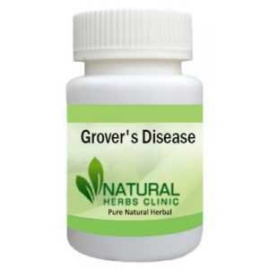 Herbal Product for Grovers Disease