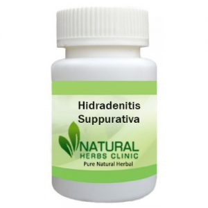 Natural Treatment for Hidradenitis Suppurativa
