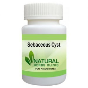 Herbal Product for Sebaceous Cyst