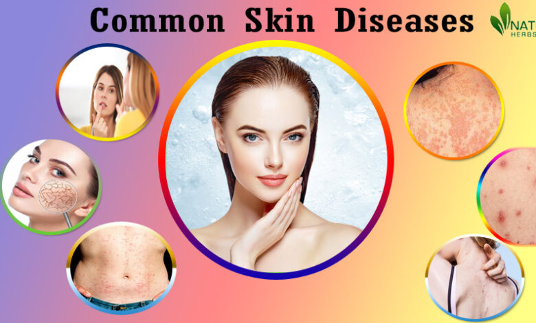 Herbal-Products-for-Skin-Diseases-1