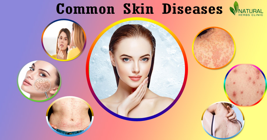 Herbal Products for Skin Diseases