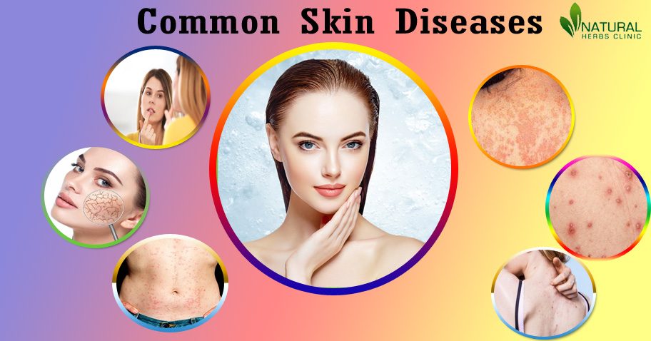 Herbal Products for Skin Diseases img