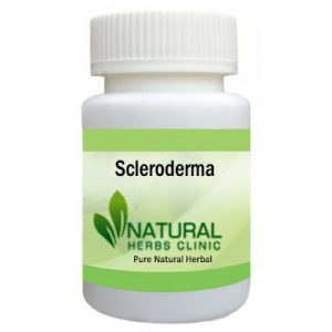 Scleroderma Natural Remedies
