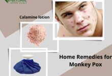 Home-Remedies-for-Monkey-Pox