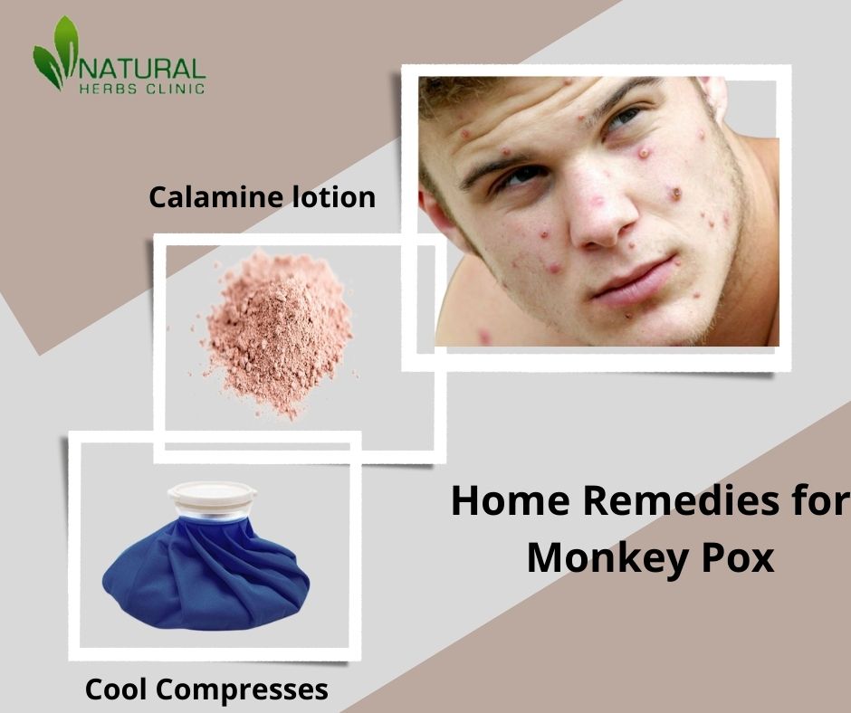 Home Remedies for Monkey Pox