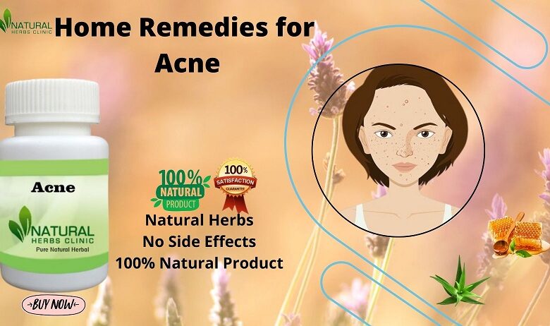 Home Remedies for Acne