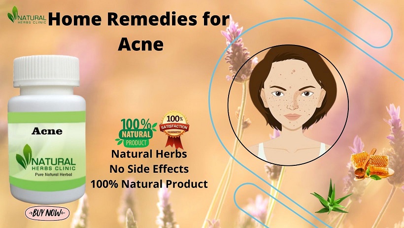 Home Remedies for Acne