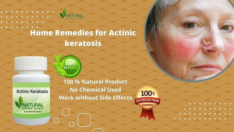 Home Remedies for Actinic keratosis