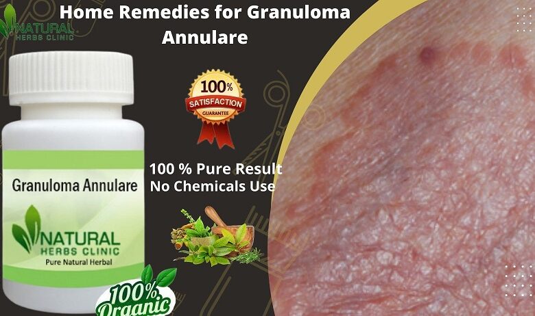 Home Remedies for Granuloma Annulare