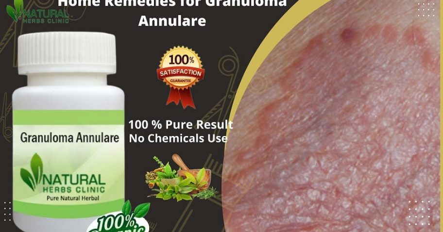 Home Remedies for Granuloma Annulare Tips to Get Rid of Skin Disease img
