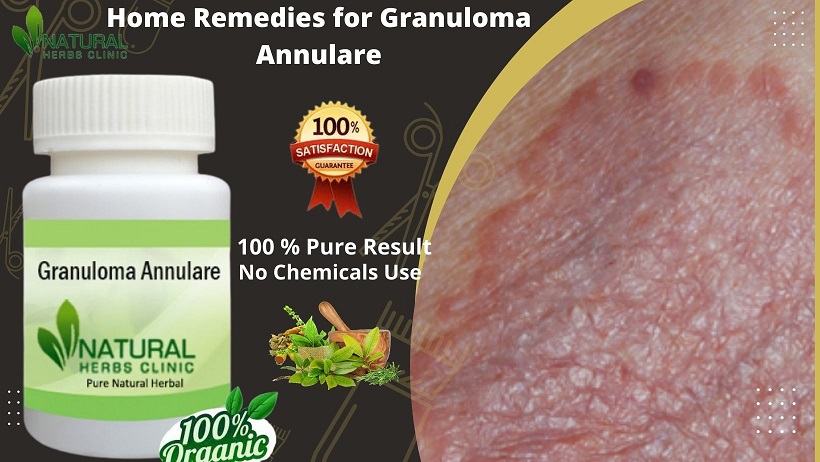 Home Remedies for Granuloma Annulare