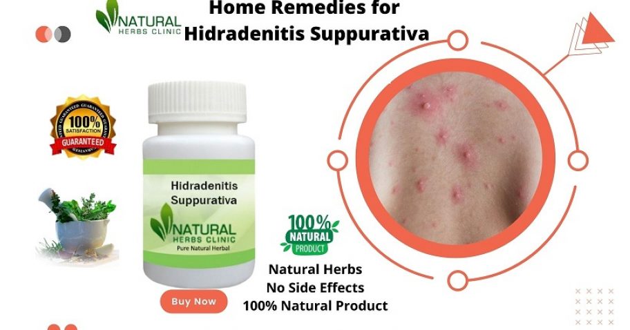 Get Hidradenitis Suppurativa Home Remedies to Relieve the Symptoms img