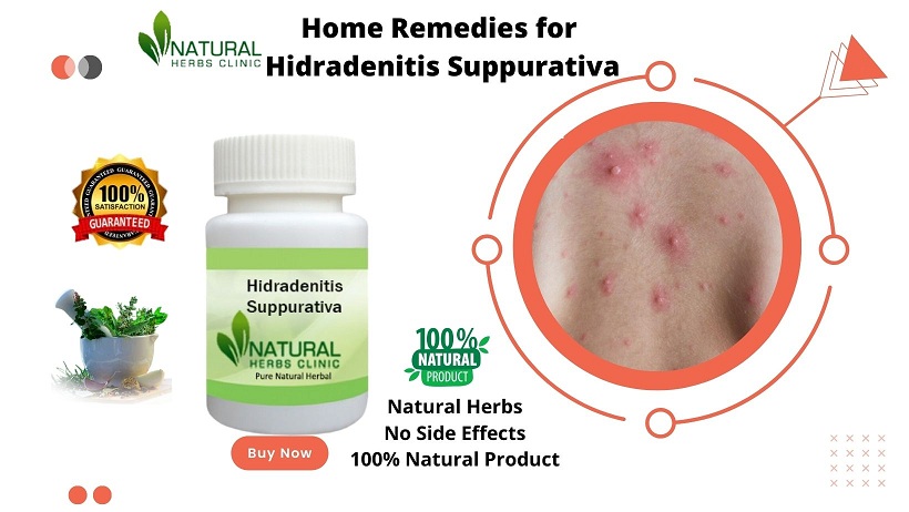 Home Remedies for Hidradenitis Suppurativa