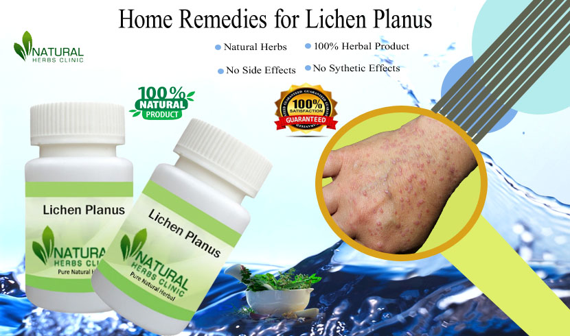 Home Remedies for Lichen Planus