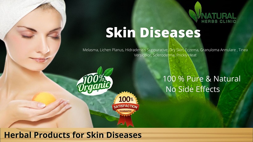 Home Remedies for Skin Diseases
