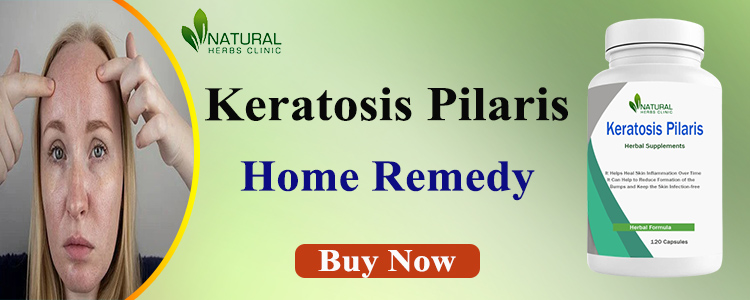 Natural Remedies for Keratosis Pilaris