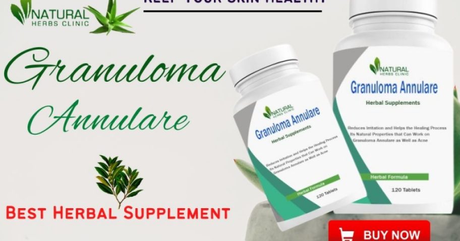Granuloma Annulare Natural Treatment img