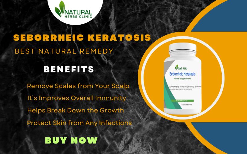 Natural Remedies for Seborrheic Keratosis