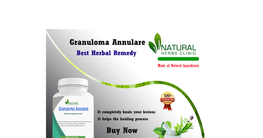 Home Remedies for Subcutaneous Granuloma Annulare Treatment Natural img