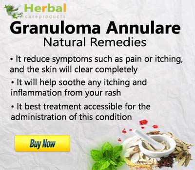 Granuloma-Annulare