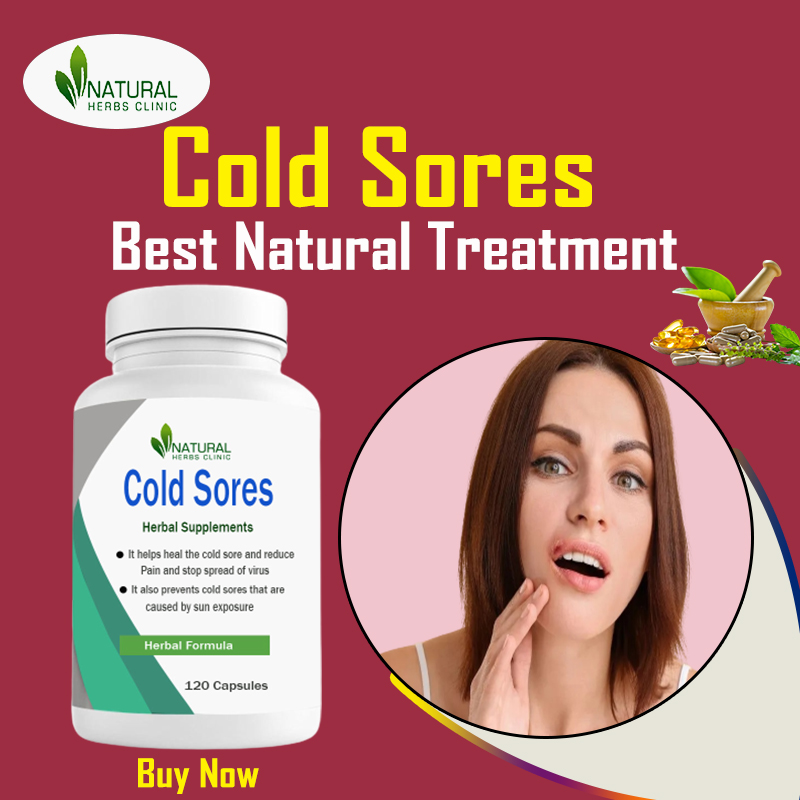 Home remedies for cold sores