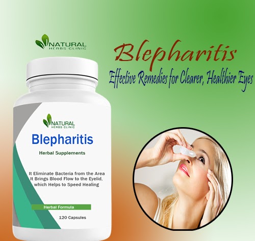 Blepharitis Natural Remedies