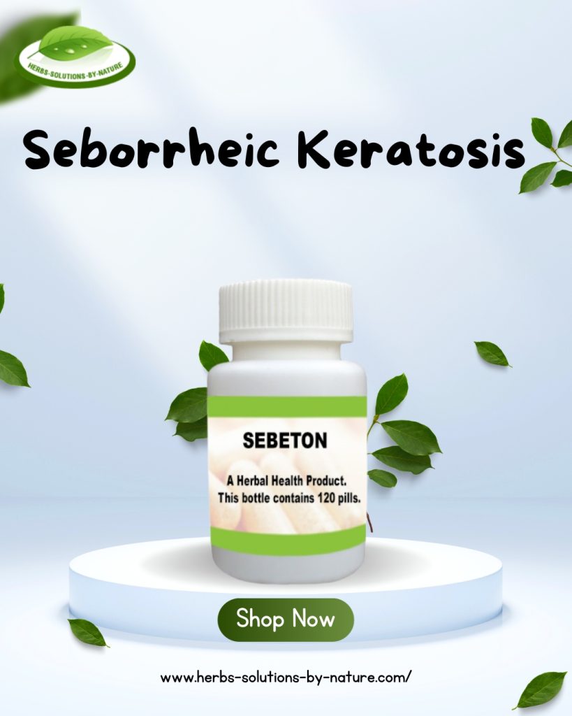 Natural Remedies for Seborrheic Keratosis